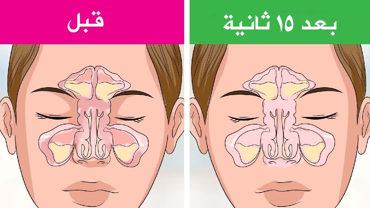 انسداد الأنف