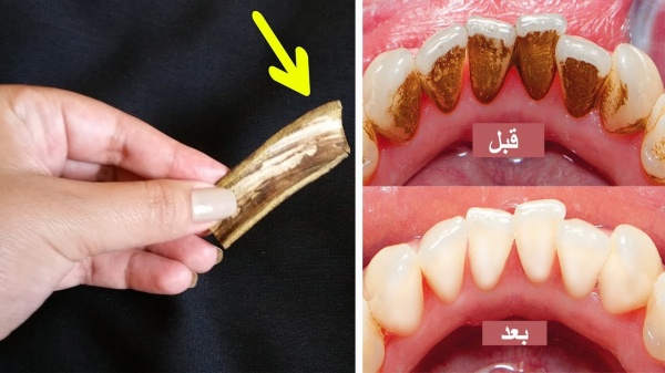 تبييض الاسنان