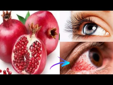 ضعف النظر