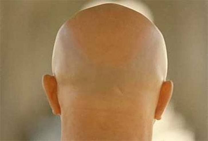 صلع