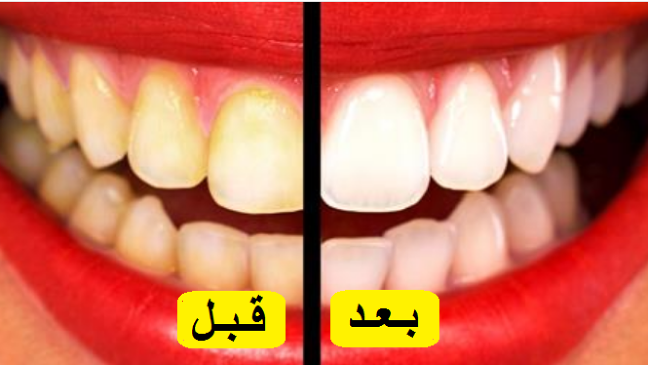 تبييض الاسنان