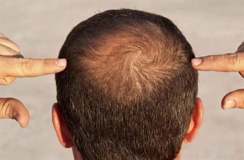 دراسة حديثة تكشف عن علامة بأصابع الرجال تدل على إصابتهم بالصلع