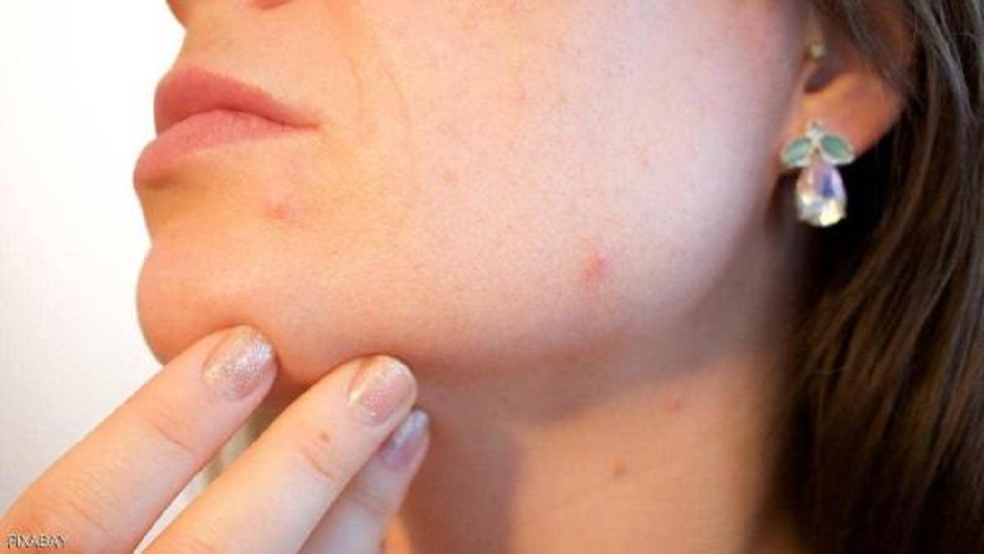 احذر بشده..  5 علامات تظهر على وجهك تدل على نقص هذه الفيتامينات.. منها حب الشباب والشفاه الشاحبة ؟