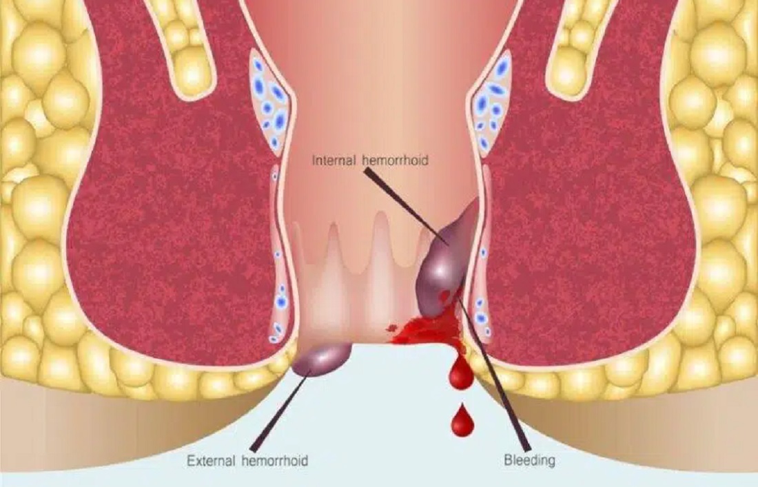 معجزة علاجية يجهلها معظم المرضى : علاج البواسير بالثلج للنساء والرجال هل هو فعال؟ ايهما افضل حمام الماء البارد أم الدافئ ؟
