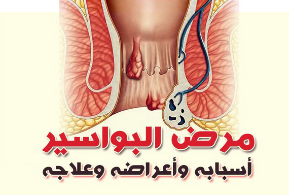 طرق علاج البواسير في المنزل