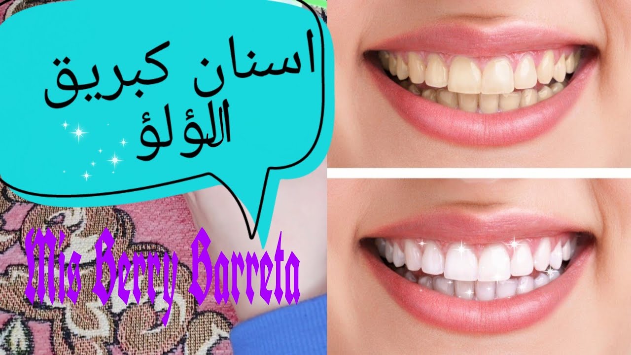 تبييض الاسنان