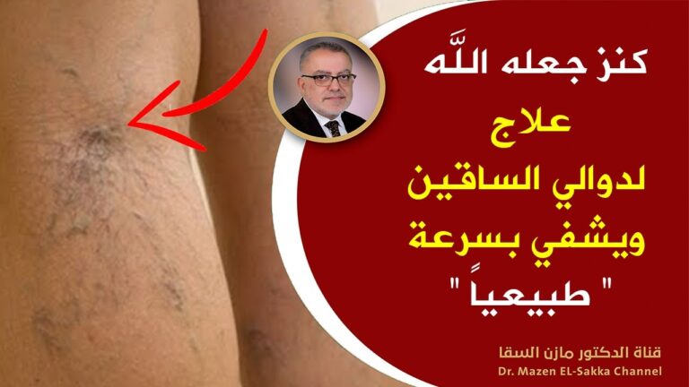 علاج الدوالي