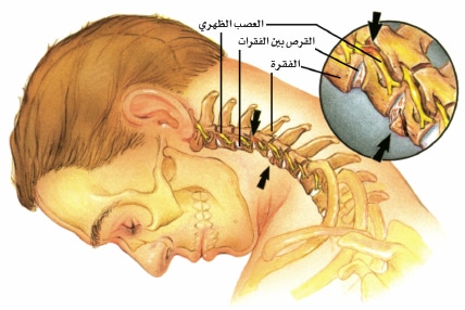 الآم الرقبة