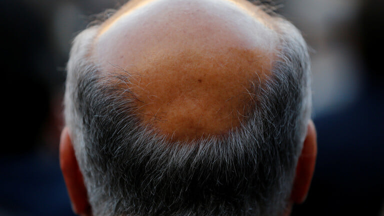 مكون يصنع المعجزة لتطويل وإنبات فراغات الشعر ومعالجة الصلع ومنع التساقط خلال أيام فقط..  طريقة التحضير