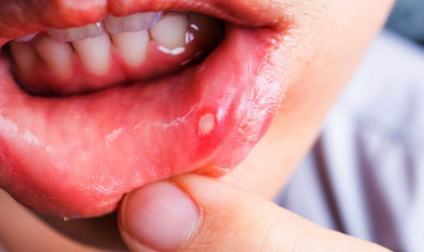  مشكلة فطريات الفم تعرف على أسبابها وكيفية علاجها 