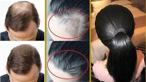 علاج تساقط الشعر و ملئ الفراغات