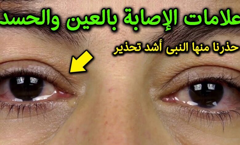 علامات الاصابة بالحسد 