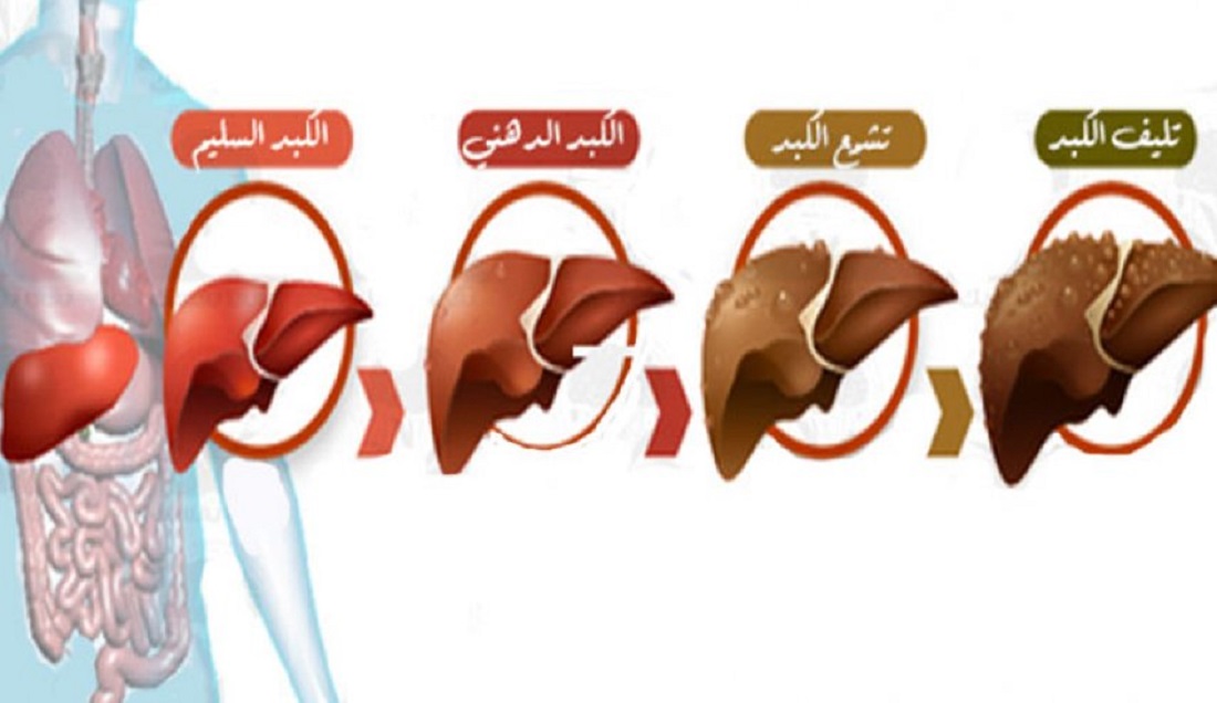 امراض الكبد