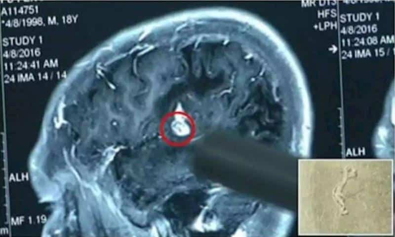 دودة شريطنية في رأس رجل