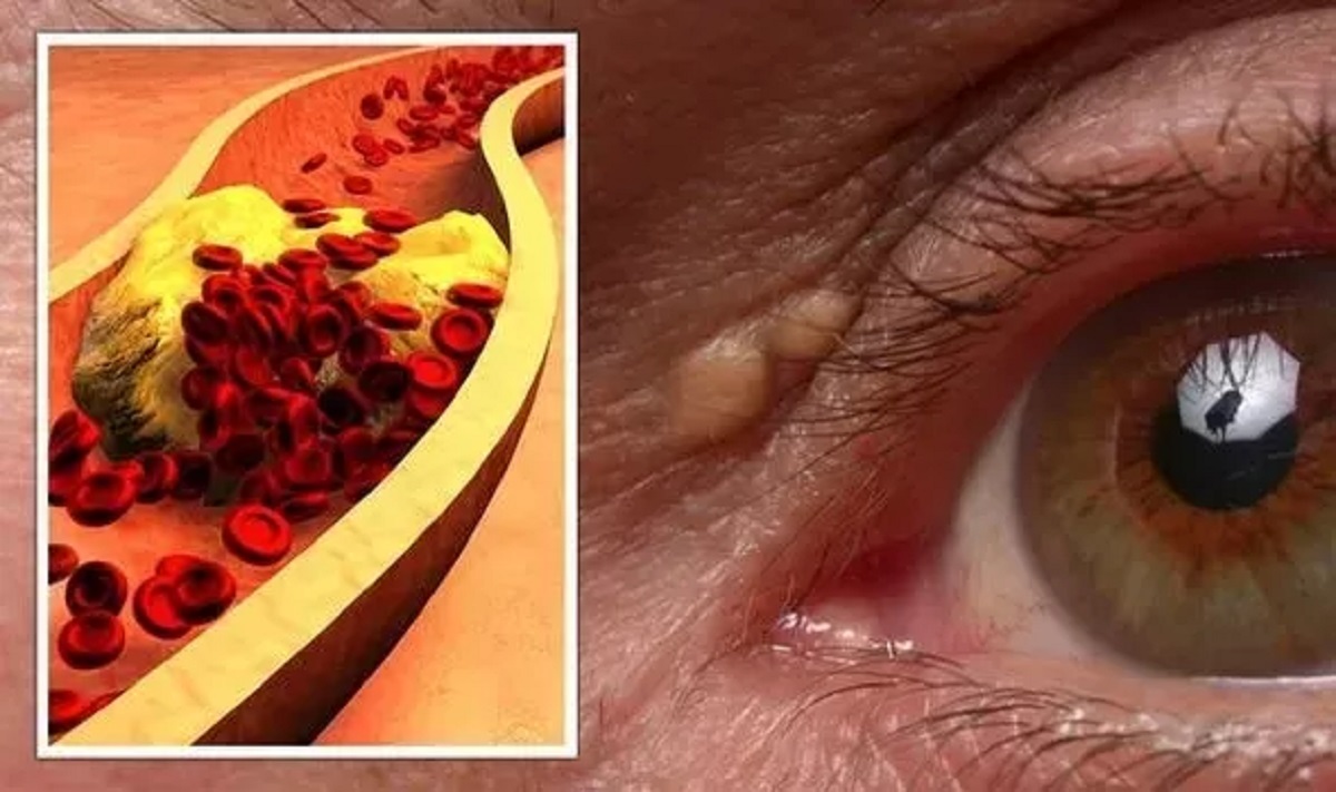 علامة حول العين تشير إلى ارتفاع الكوليسترول في الدم